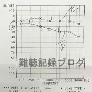 絶対治す！右耳の突発性難聴から3年経過。私が難聴になった経緯