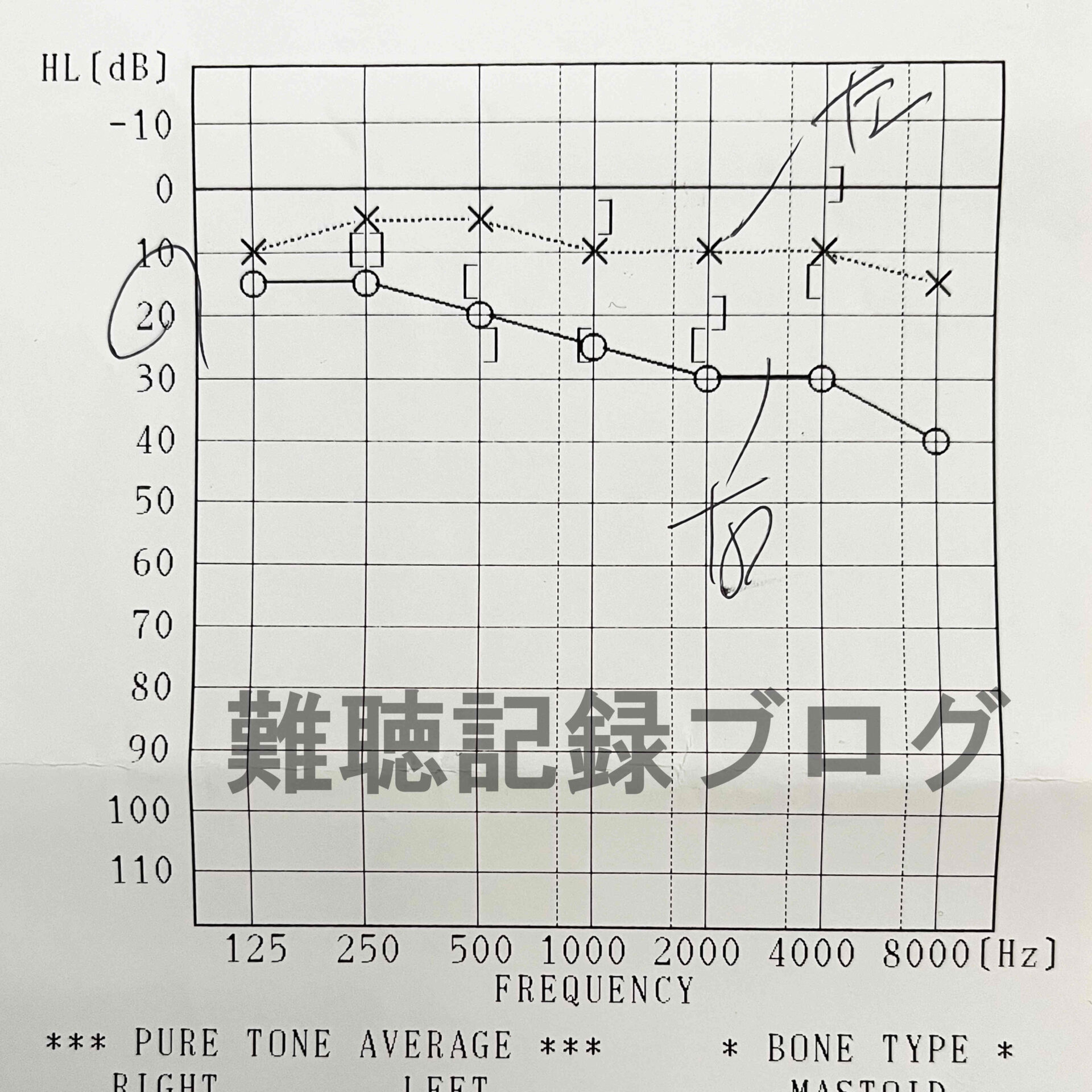 絶対治す！右耳の突発性難聴から3年経過。私が難聴になった経緯