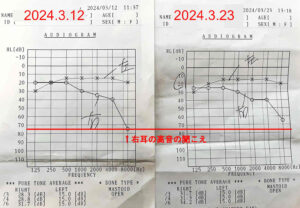 経過報告② 投薬開始2週間後の聴力検査結果や症状のまとめ／突発性難聴再発記録
