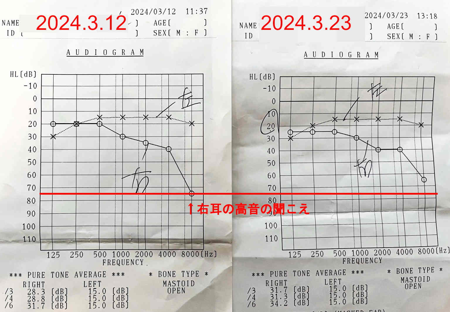 経過報告② 投薬開始2週間後の聴力検査結果や症状のまとめ／突発性難聴再発記録