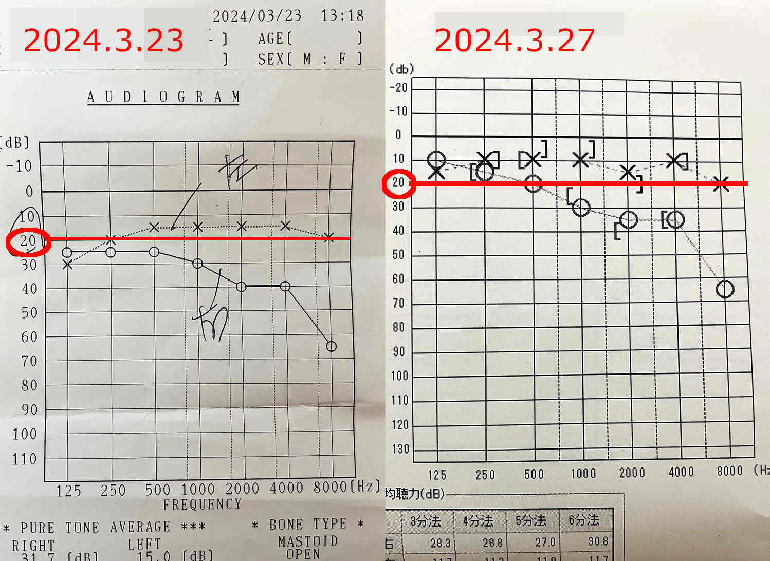 経過報告③総合病院で検査！なぜか良くなっている聴力検査…突発性難聴再発記録