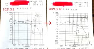 経過報告①難聴悪化通院から投薬開始1週間後の聴力検査結果や症状のまとめ／難聴再発記録