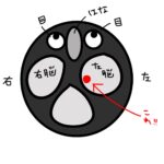 経過報告④MRIの結果、左脳にくも膜のう胞発見！右耳難聴との関係は？突発性難聴記録